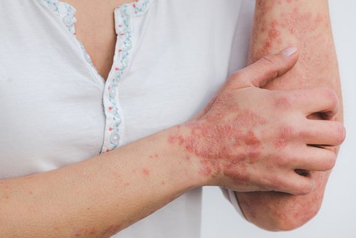 How To Cure Psoriasis